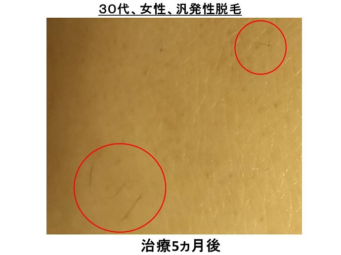 円形脱毛症　病院